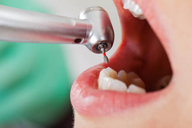 Best Emergency Dental Care for Broken or Chipped Teeth in Tariffville, CT